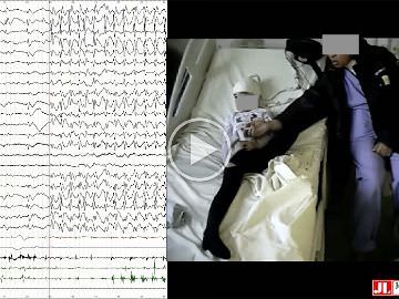 Jerking during absences: video-EEG and polygraphy of epileptic myoclonus associated with two paediatric epilepsy syndromes