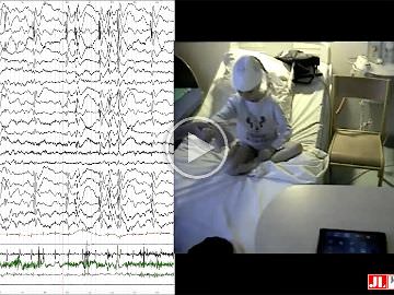 Jerking during absences: video-EEG and polygraphy of epileptic myoclonus associated with two paediatric epilepsy syndromes