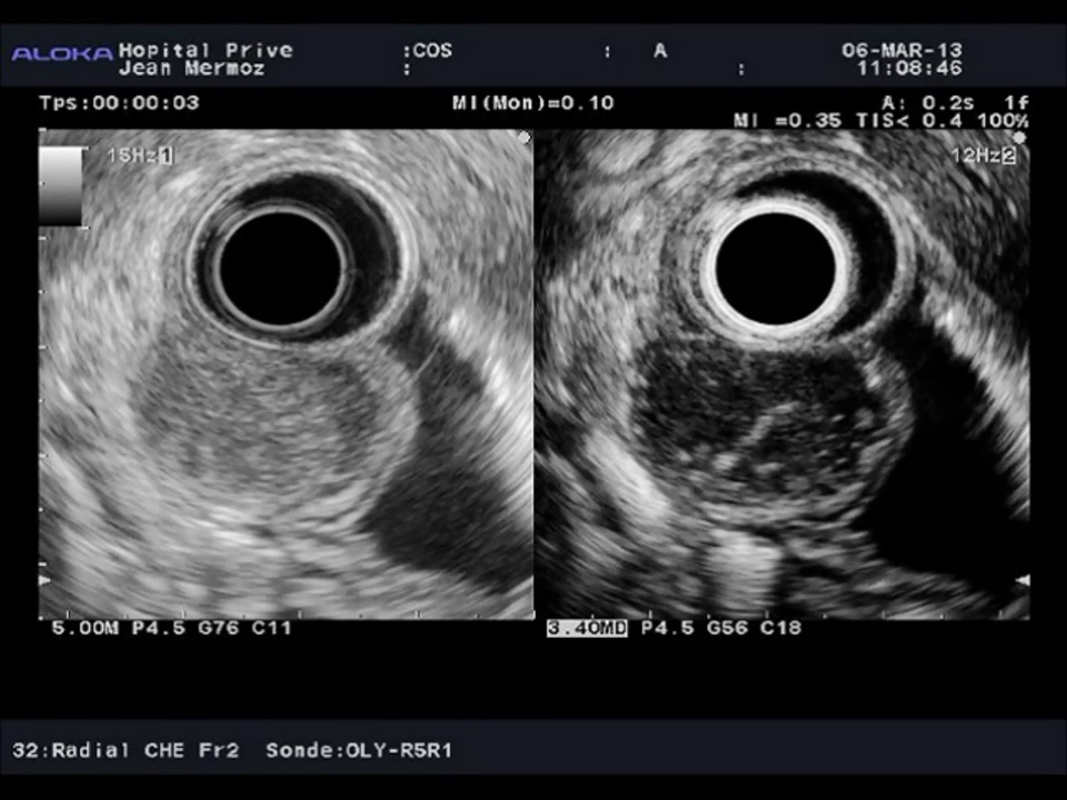 Rôle de l’écho-endoscopie dans le diagnostic et la prise en charge des tumeurs sous-épithéliales digestives