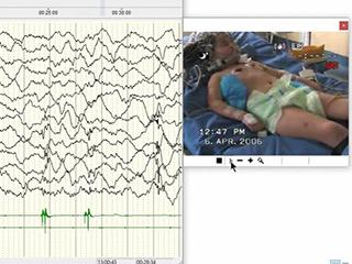 Epilepsia partialis continua associated with the p.Arg403Cys variant of the DNM1L gene: an unusual clinical progression with two episodes of super-refractory status epilepticus with a 13-year remission interval