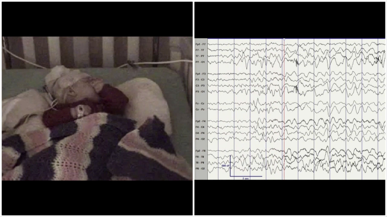 Hypermotor-tonic-spasms seizure sequence related to CDKL5 deficiency disorder: a typical case