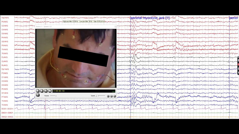 Visual word form area hyperexcitability associated with focal epileptiform activity in a case of reading epilepsy