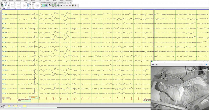 Tardive myoclonic focal seizures after electroconvulsive therapy, lithium and bupropion treatment