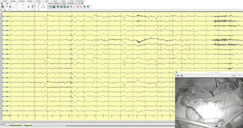 Tardive myoclonic focal seizures after electroconvulsive therapy, lithium and bupropion treatment