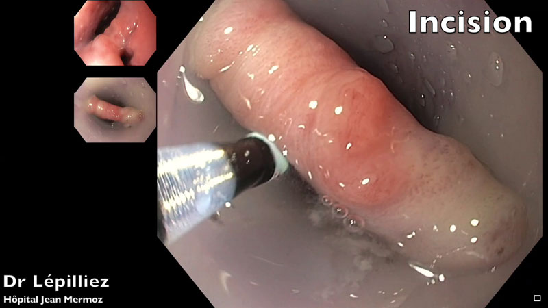 Septotomie endoscopique souple avec diverticuloscope