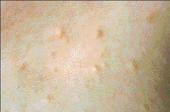 John Libbey Eurotext European Journal Of Dermatology Eruptive
