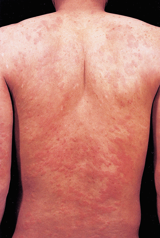 john libbey eurotext european journal of dermatology still s disease
