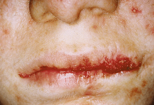 dermal papillomatosis