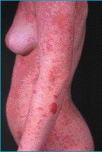 Les onguents au psoriasis non les hormonaux