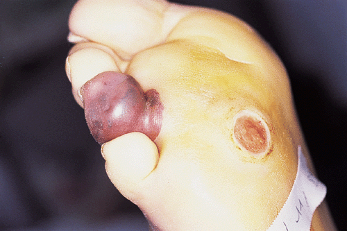Se soigner la thrombose des veines profondes