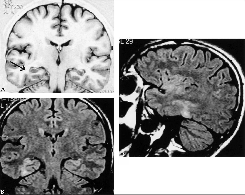 neuropathological disorders Neuropathological seizure 1 neuro-pathological seizure disorders nakia melecio doctoral candidate neuropathological seizure disorders there are many neuropathological disorders that plague people all over the world these brain disorders may be simple and treatable, such as mood disorders. neuropathological disorders Neuropathological seizure 1 neuro-pathological seizure disorders nakia melecio doctoral candidate neuropathological seizure disorders there are many neuropathological disorders that plague people all over the world these brain disorders may be simple and treatable, such as mood disorders.