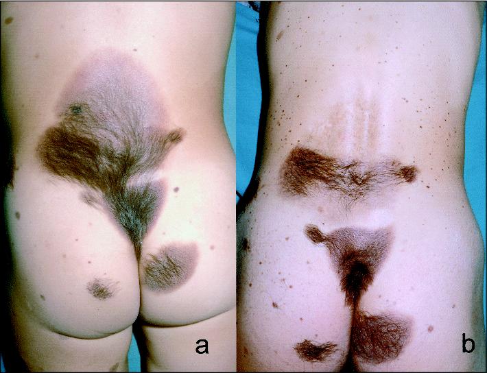 melanocytic nevus with melanocytic nevus with