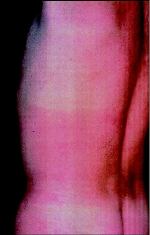 Macular Erythema