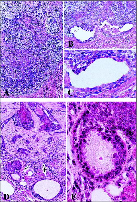 John Libbey Eurotext European Journal Of Dermatology Basal Cell Carcinoma With Ductal And Glandular Differentiation A Clinicopathological And Immunohistochemical Study Of 10 Cases