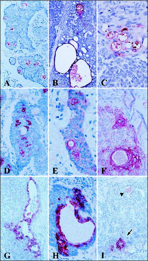 John Libbey Eurotext European Journal Of Dermatology Basal Cell Carcinoma With Ductal And Glandular Differentiation A Clinicopathological And Immunohistochemical Study Of 10 Cases