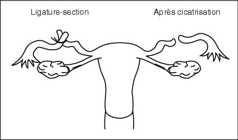Ligature des trompes