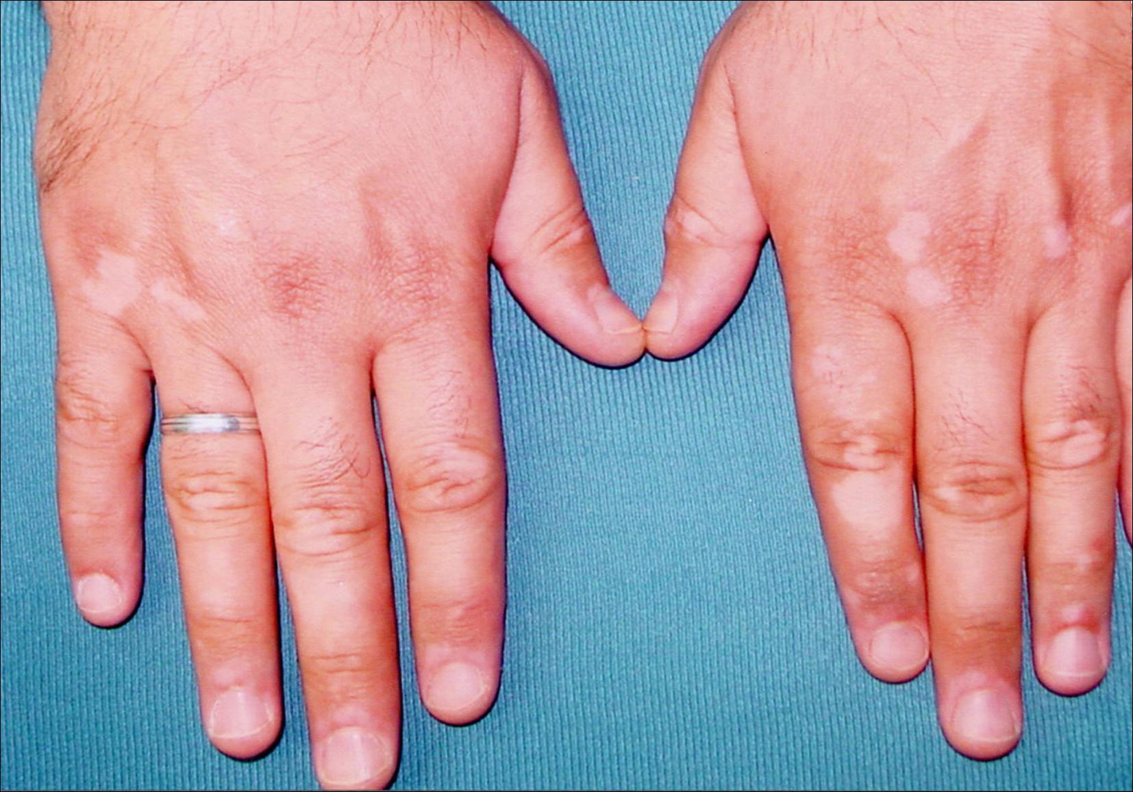 Treatment For Vitiligo On The Nhs : Diverse Approaches On The Best Way To Repigment Vitiligo Affected Skin