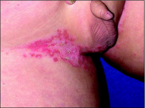 Sharply demarcated erythematous plaques at the axillae areola of the Sharply demarcated erythematous plaques at the axillae areola of the