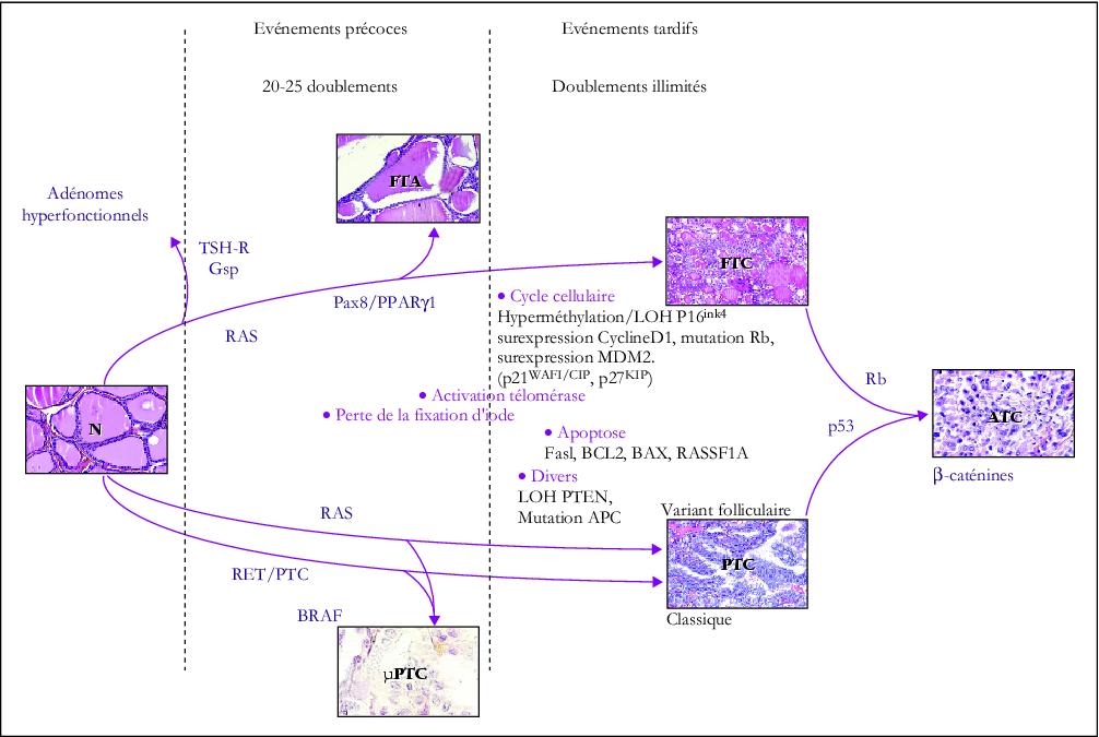 cancer papillaire thyroide
