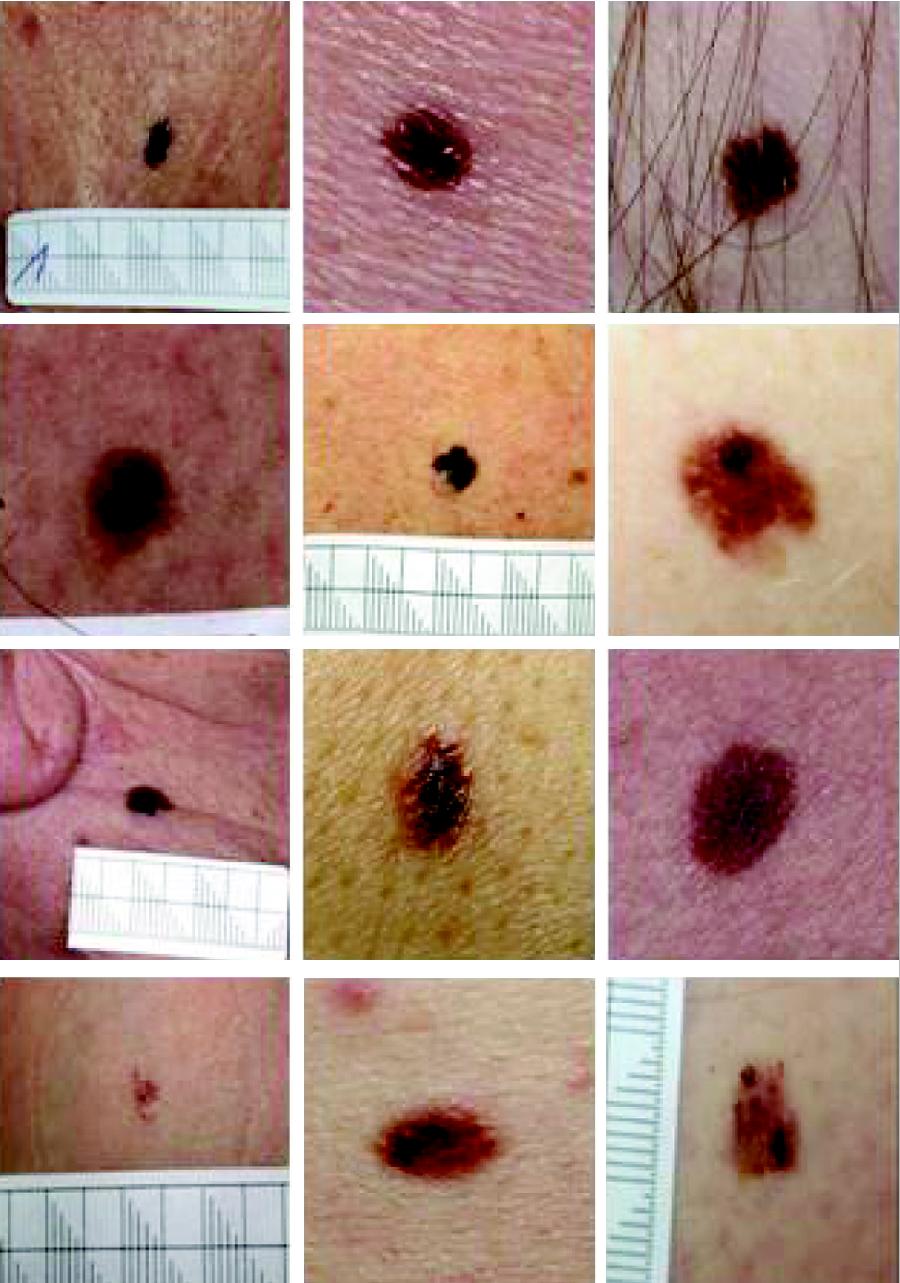 Benign Nevus Vs Melanoma benign-nevus-vs-melanoma