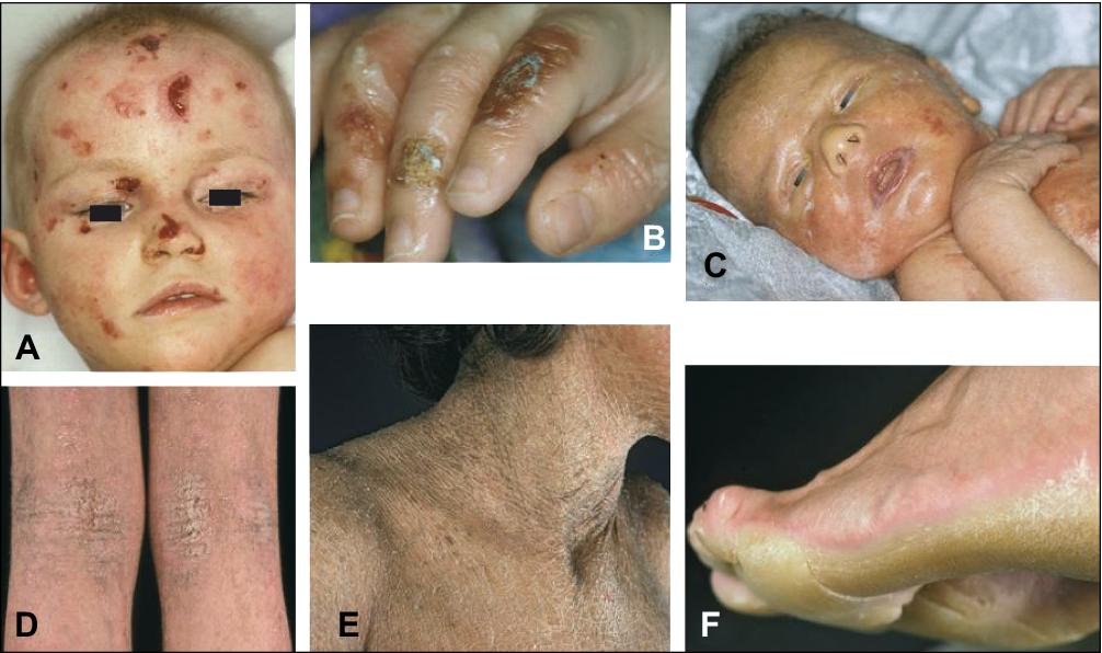 Blister Formation