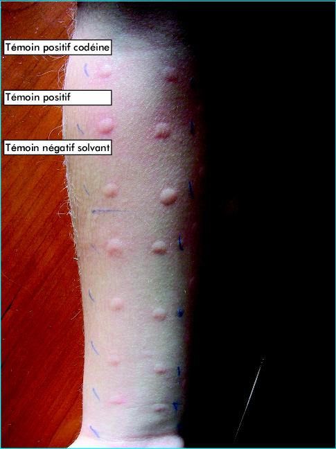Les préparations pour le traitement de lhypertension au psoriasis