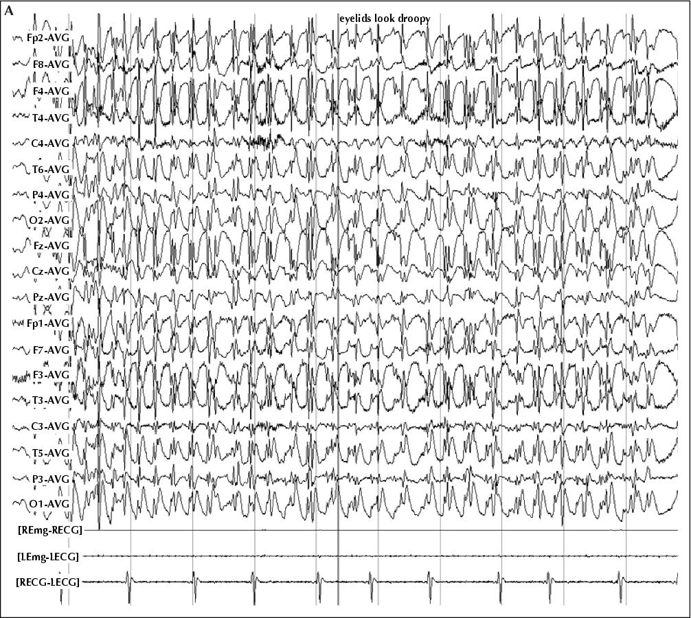 eeg absence seizure hyperventilation eeg absence seizure hyperventilation