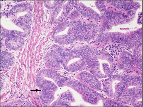 neurológia és prostatitis