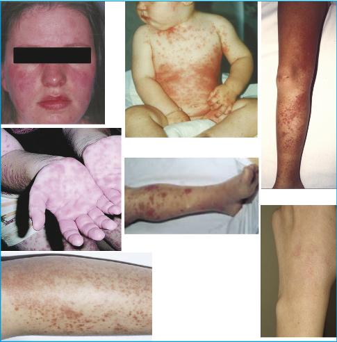 Steroid skin syndrome