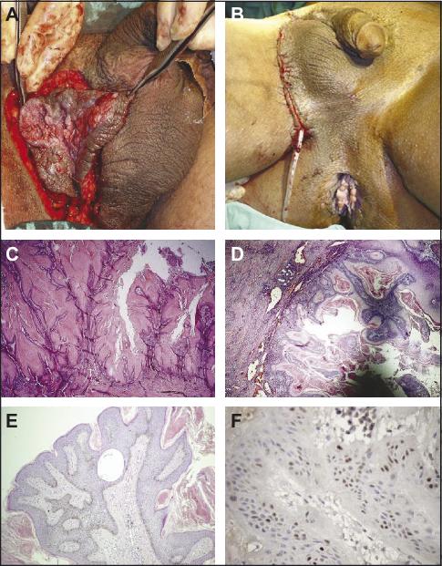 condilom la anus sens duodenal