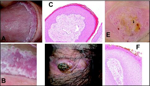 In penis papules Pearly Penile