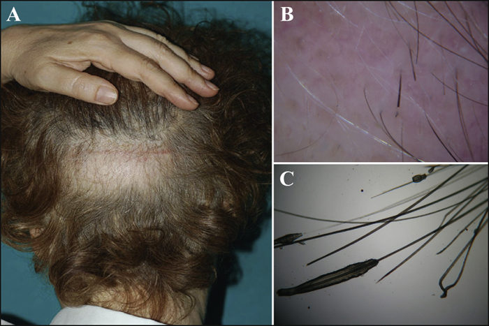 John Libbey Eurotext - European Journal of Dermatology - Alopecia areata as  a complication of hair restoration surgery