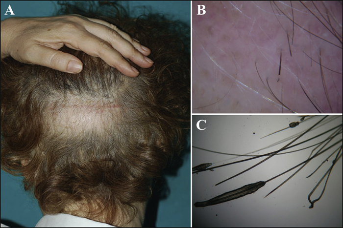 John Libbey Eurotext - European Journal of Dermatology - Alopecia areata as a complication of hair restoration surgery John Libbey Eurotext - European Journal of Dermatology - Alopecia areata as a complication of hair restoration surgery