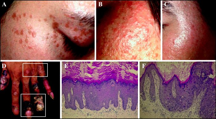 human papillomavirus induced warts