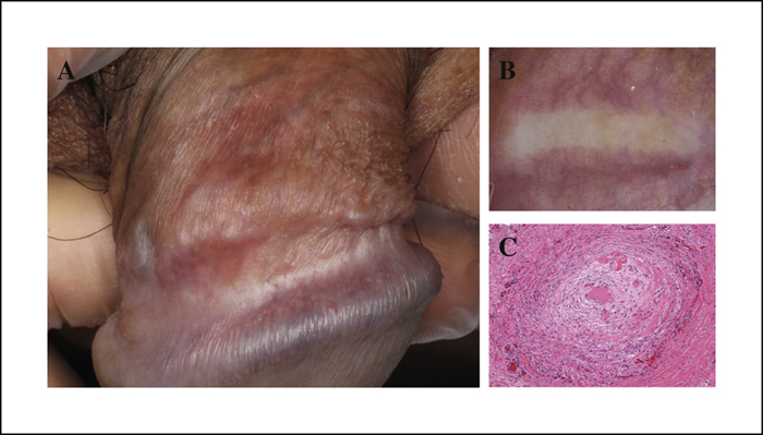 Want Penis disease pictures was