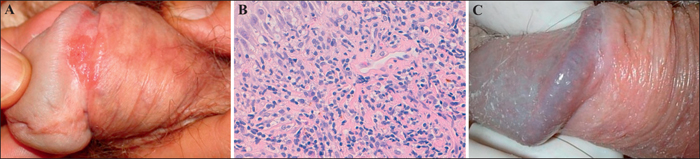 Plasma+Cell+Balanitis+of+Zoon ... Journal of Dermatology - Photodynamic therapy for Zoon balanitis
