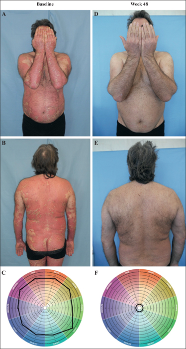 pasi psoriasis pdf