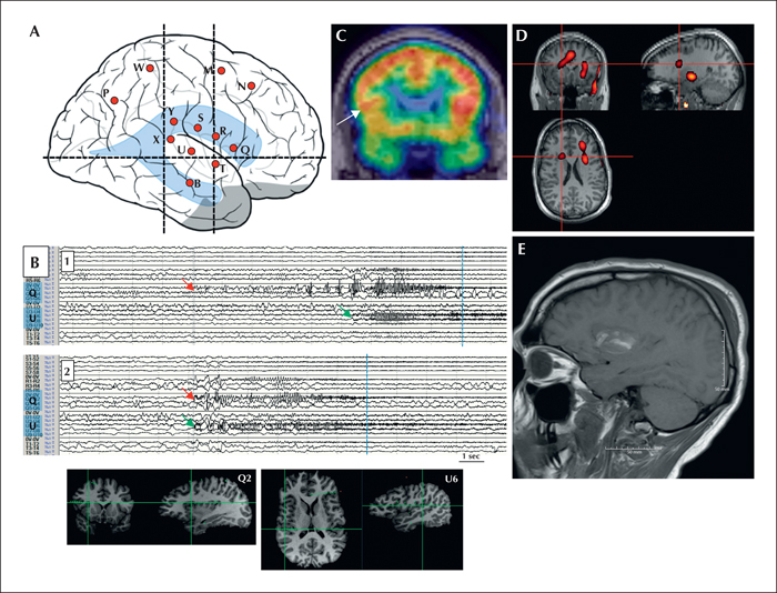 aura definition epilepsy aura definition epilepsy