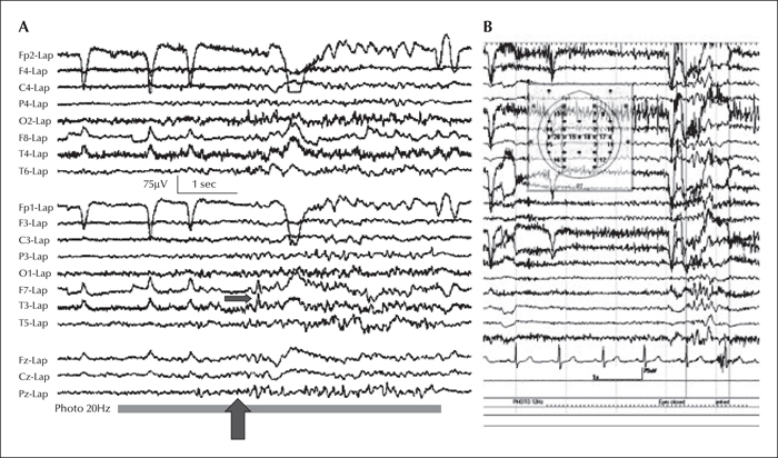 Adult Seizure 79