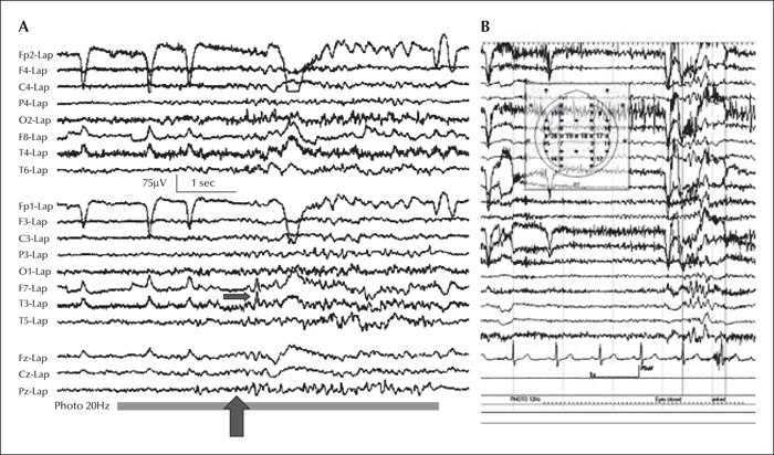 Adult Onset Seizure Disorder 107