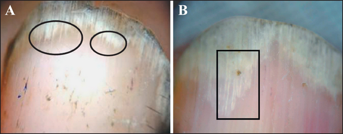 Dr. Diag - Onychomycosis