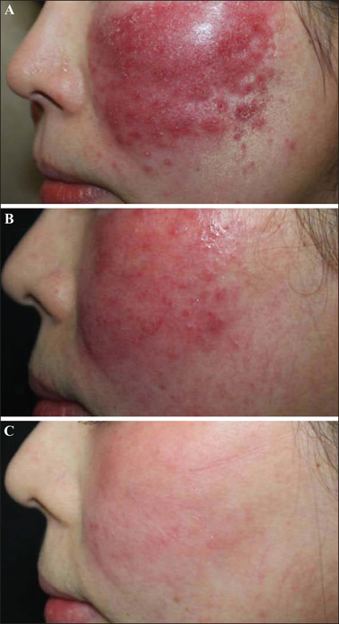 Steroid Induced Rosacea .......Causes, Treatment Options