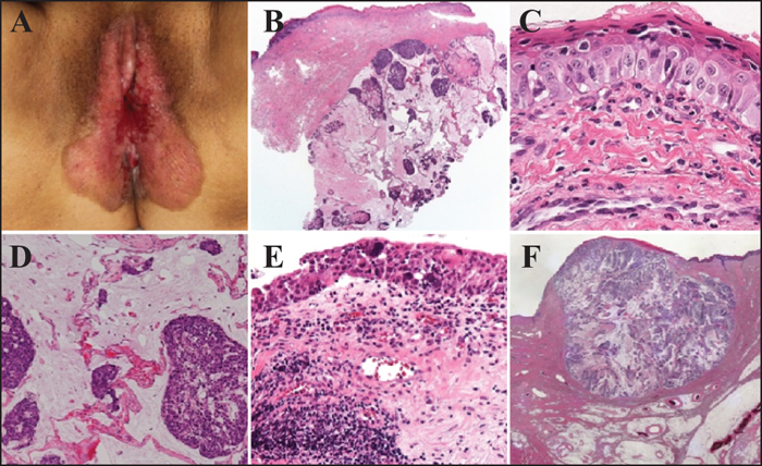 philips bliss bikini pagets disease of the vulva picture
