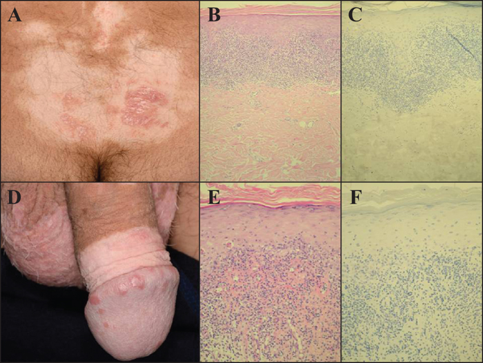 vitiligo pénisz az erekció farkra esik