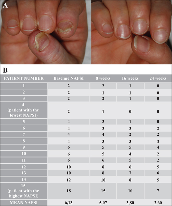 napsi psoriasis)