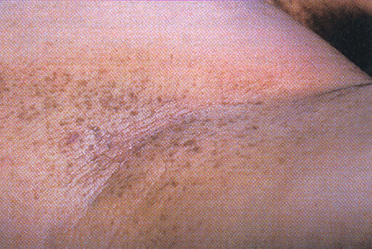 Dowling Degos Disease Reticulate Pigmented Anomaly Of The Flexures Pictures