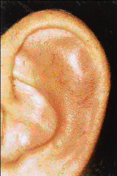 Auricular Pseudocyst