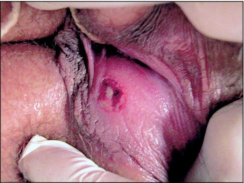 and adolescentfeb Vulva