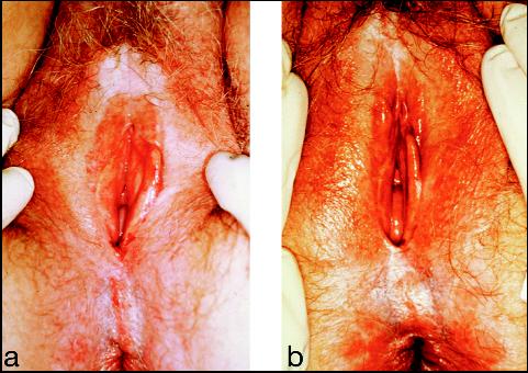 Vulva of a patient with lichen sclerosus (a) before and (b) after 6 weeks of 