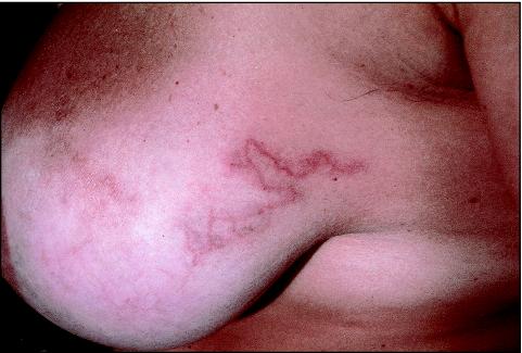 larvae breast. Larvae of Dermatobia hominis